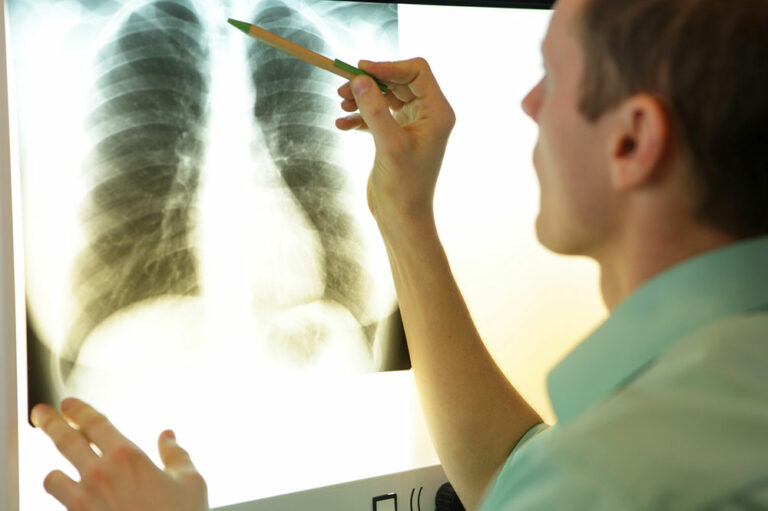 MAC lung disease &#8211; 8 common signs and management options