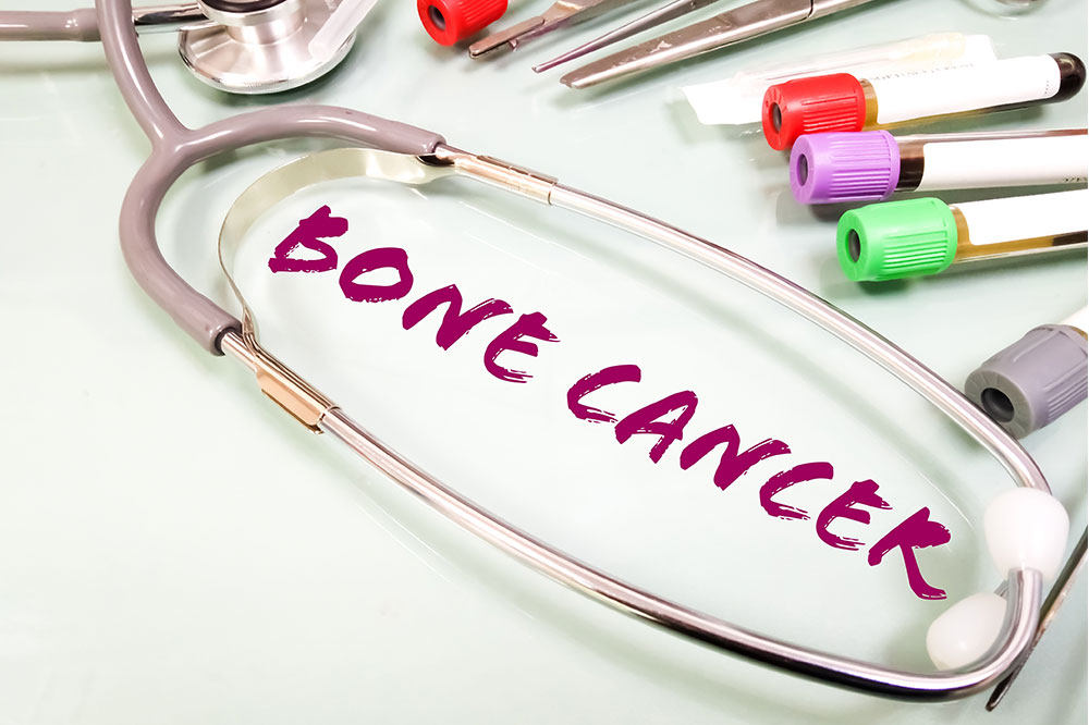 7 warning signs of bone cancer to be aware of